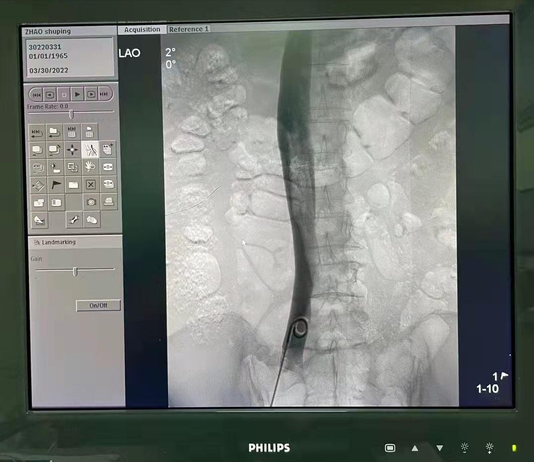 石膏拆了还未消肿怎么回事,长期卧床要注意预防肺栓塞