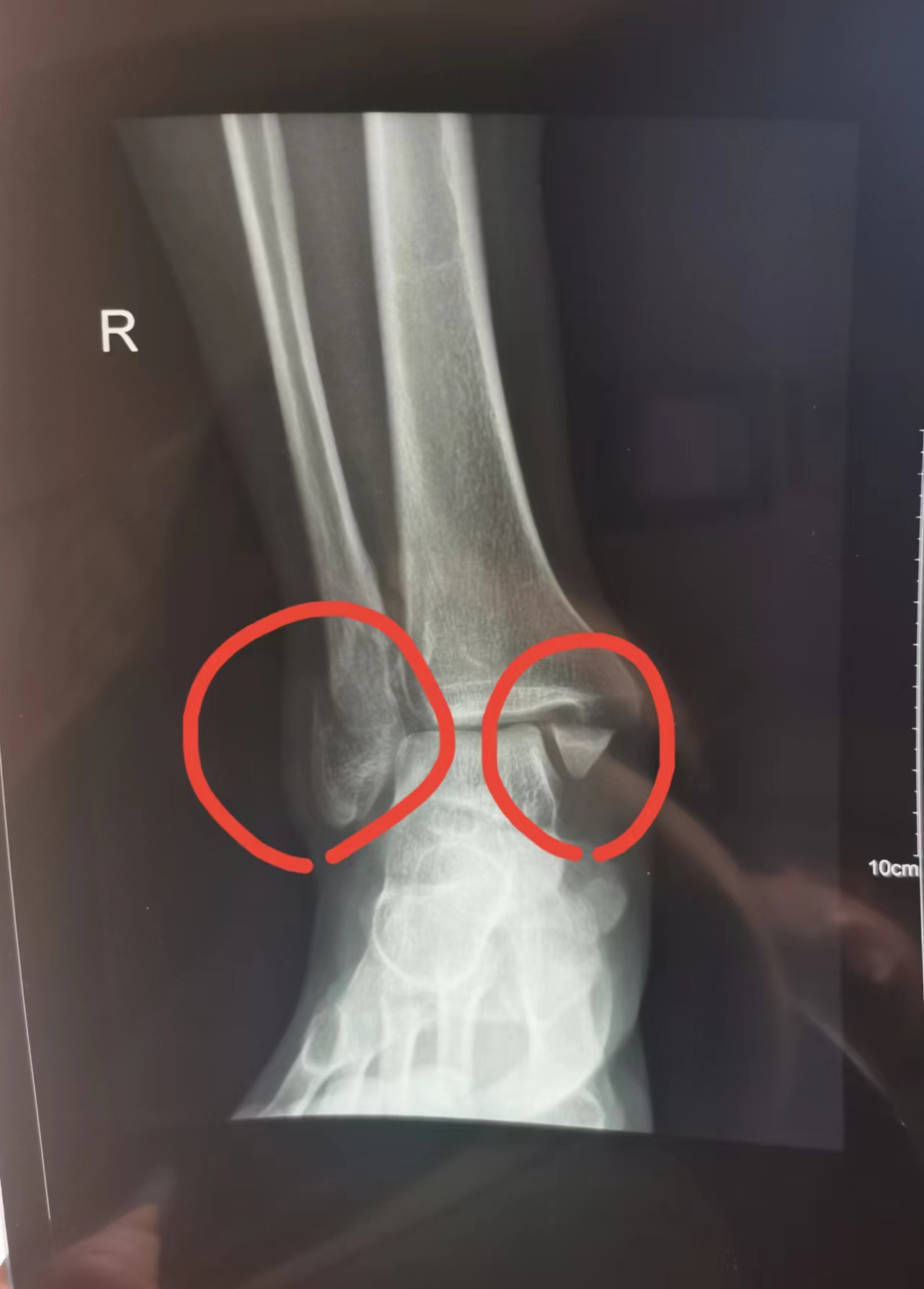 脚踝上侧骨折手术的全过程,脚踝骨折手术费用多少