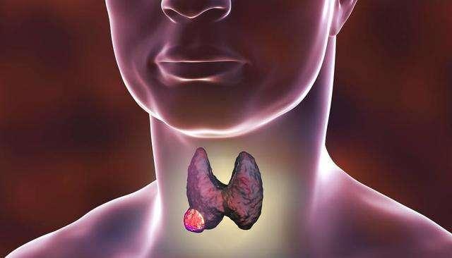 癌症转移时有哪些表现5个方法可预防