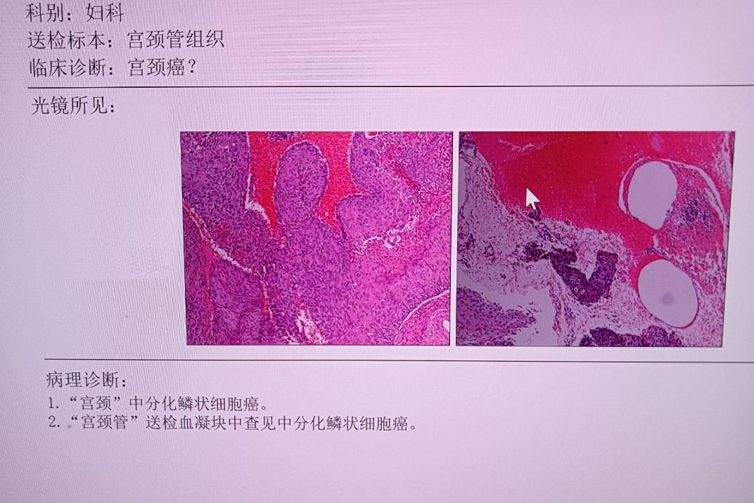 HPV感染和宫颈癌的预防与早期发现