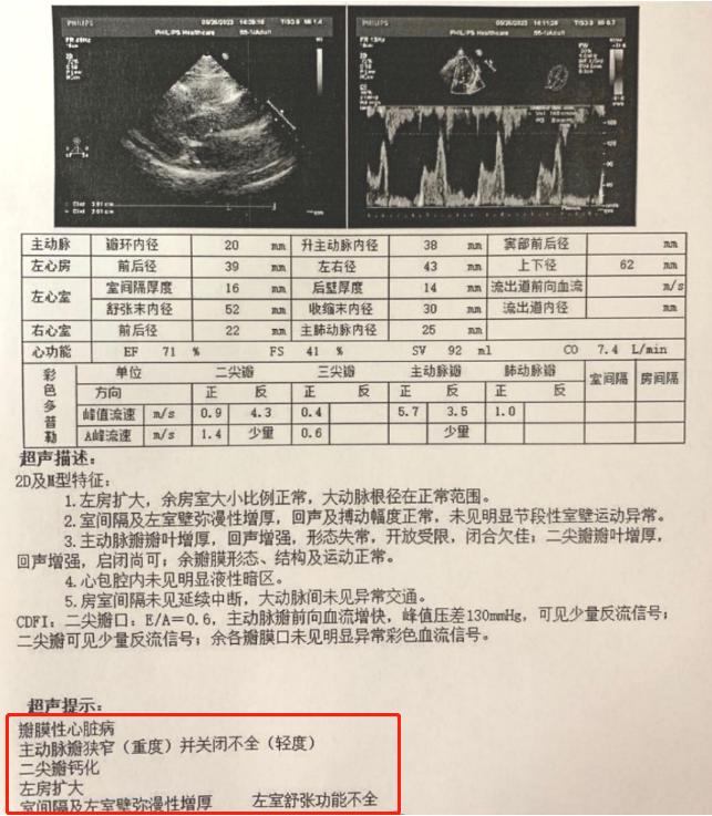 河南大学淮河医院顺利为一例二叶式主动脉瓣重度狭窄伴重度钙化的病人实施了经导管主动脉瓣置换术