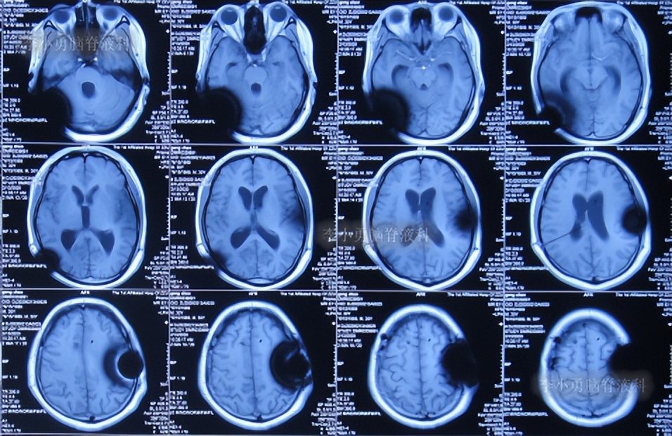 脑积水三脑室造瘘多久能恢复,脑囊虫手术后脑积水