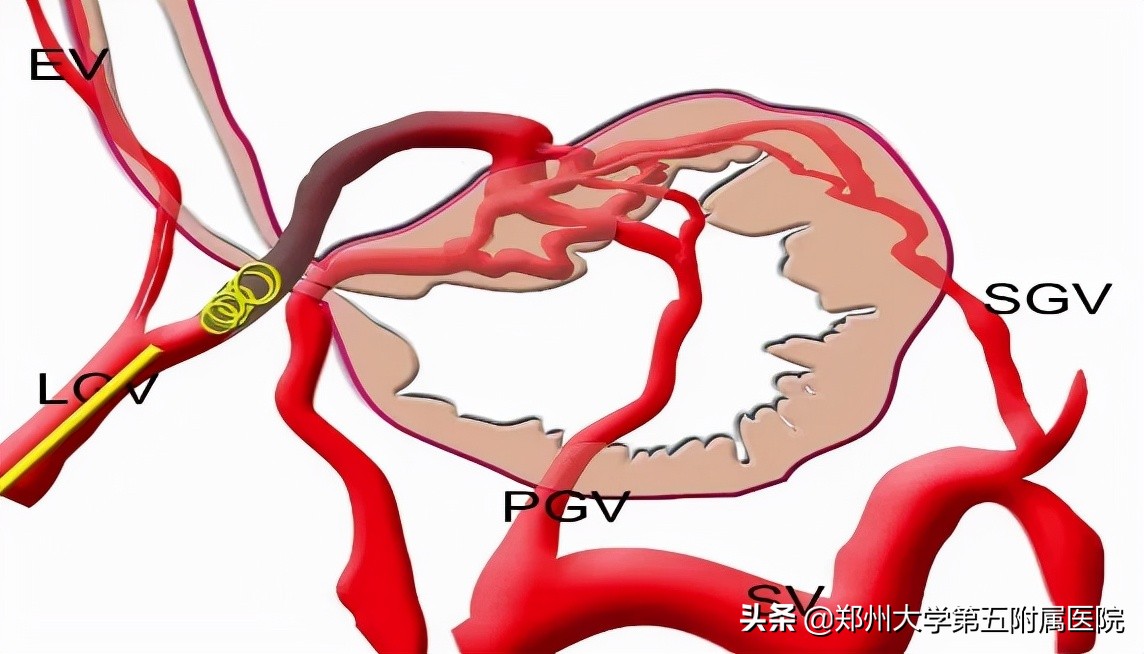 食管胃底静脉曲张破裂二次出血,胃底静脉曲张破裂出血致死