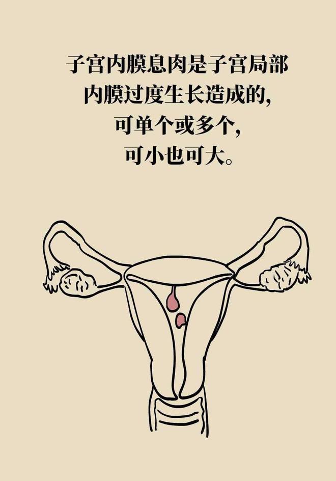 子宫检查发现息肉会是癌症吗,体检发现息肉会直接切除吗