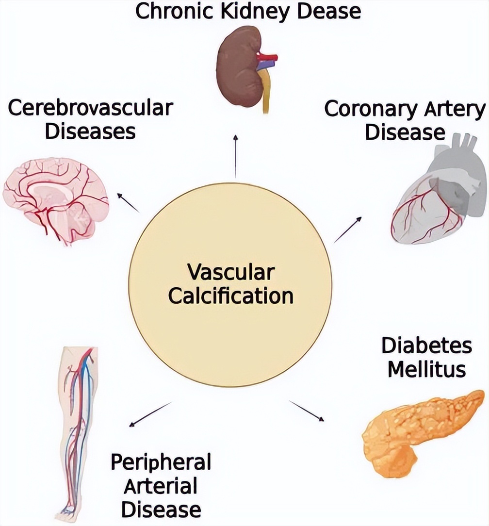血管钙化的治疗方案,血管钙化的近年研究现状
