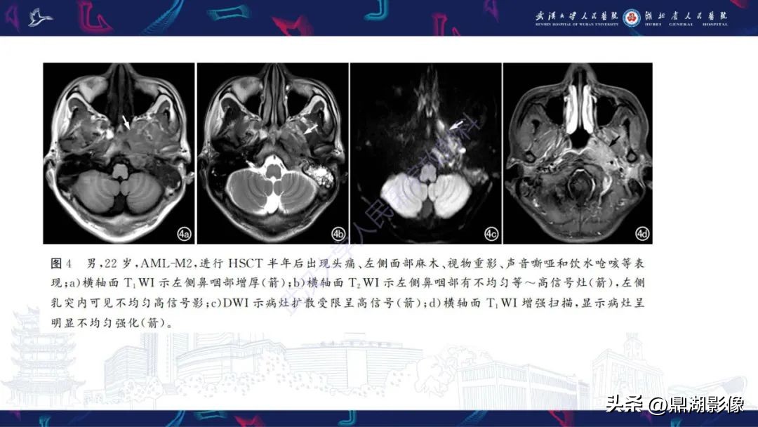 阴道肉瘤症状,阴道肉瘤的早期症状