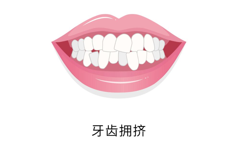 小孩换完牙牙齿长歪能戴牙套吗,孩子换了八颗牙可否矫正