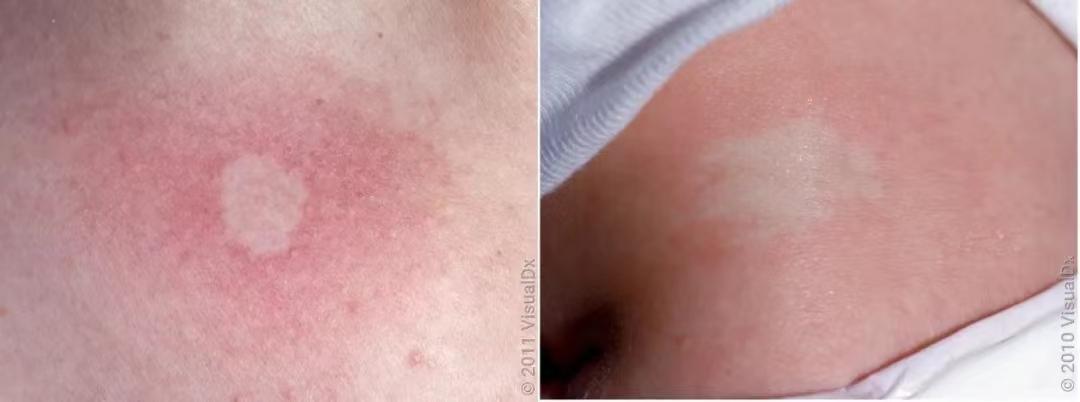 18种皮肤病白斑病,常见皮肤病斑