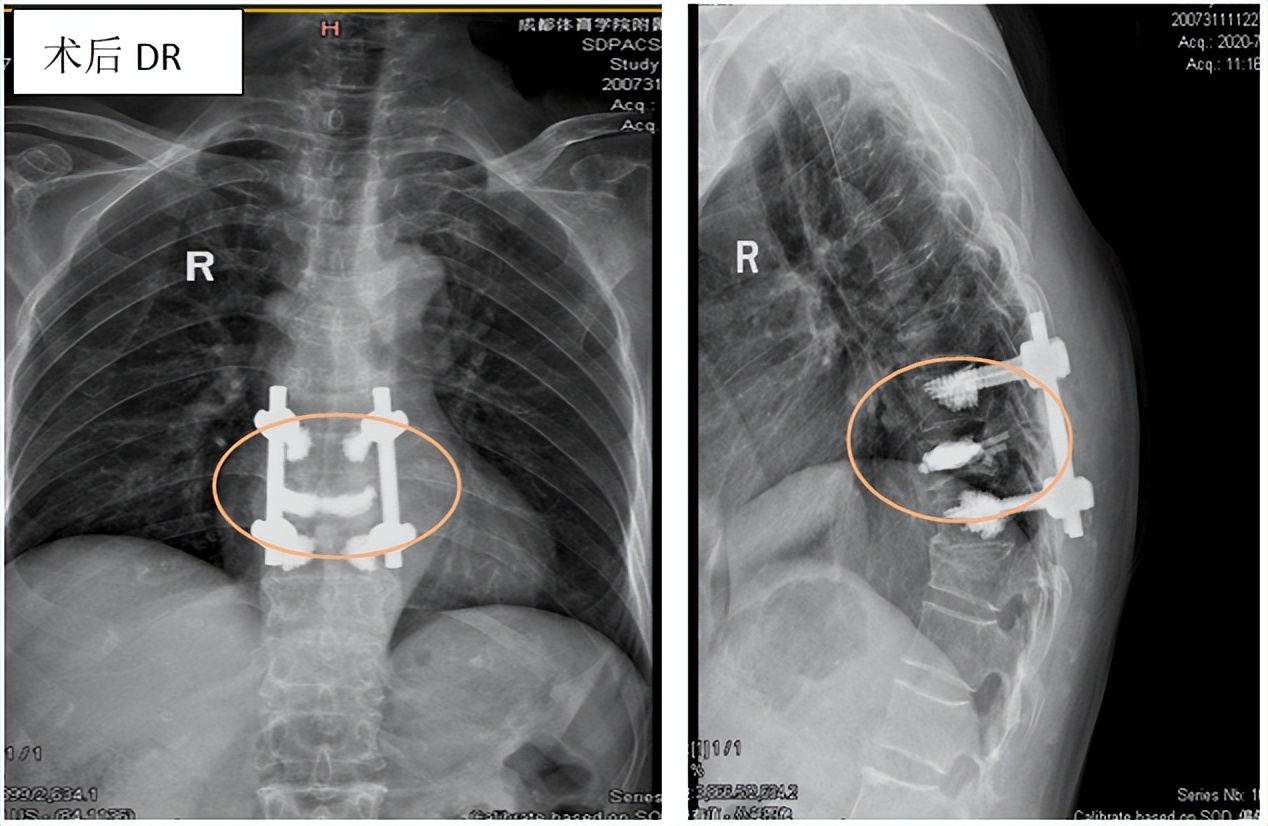 胸腰椎压缩性骨折特色治疗方法,老年人胸腰椎骨折怎么治疗