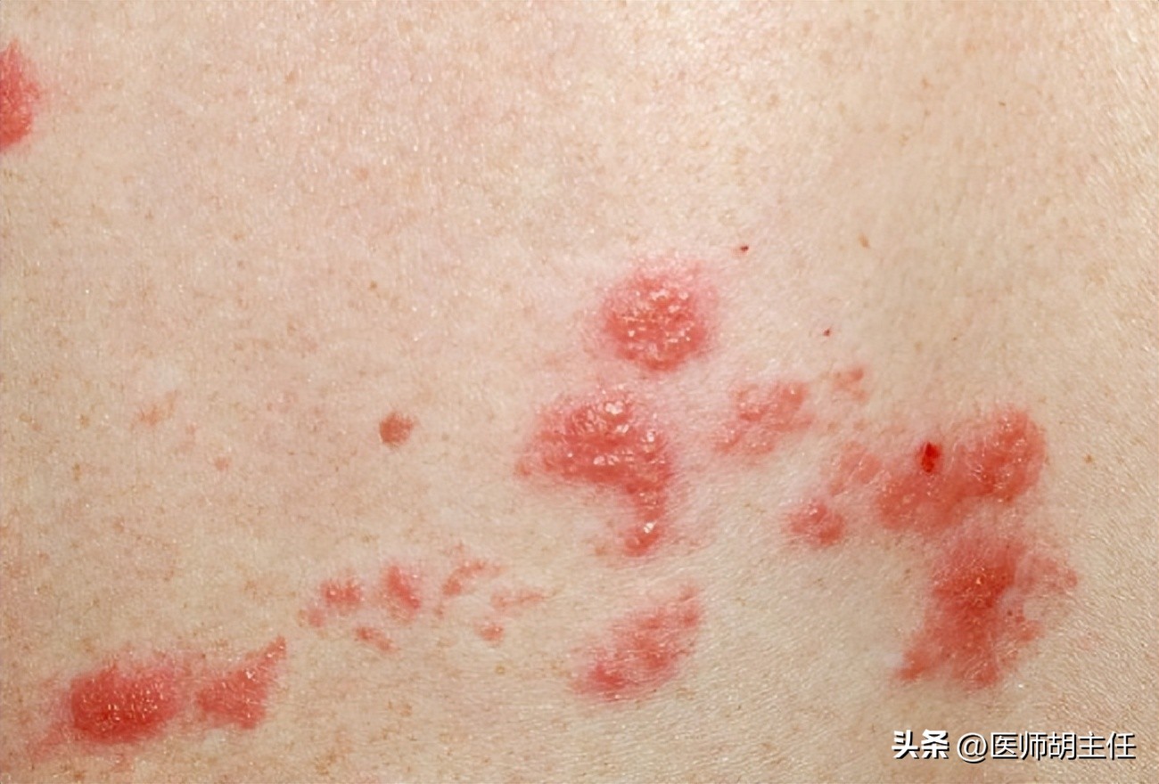 带状疱疹缠腰蛇为什么会头痛,蛇缠腰带状疱疹怎么才算治好