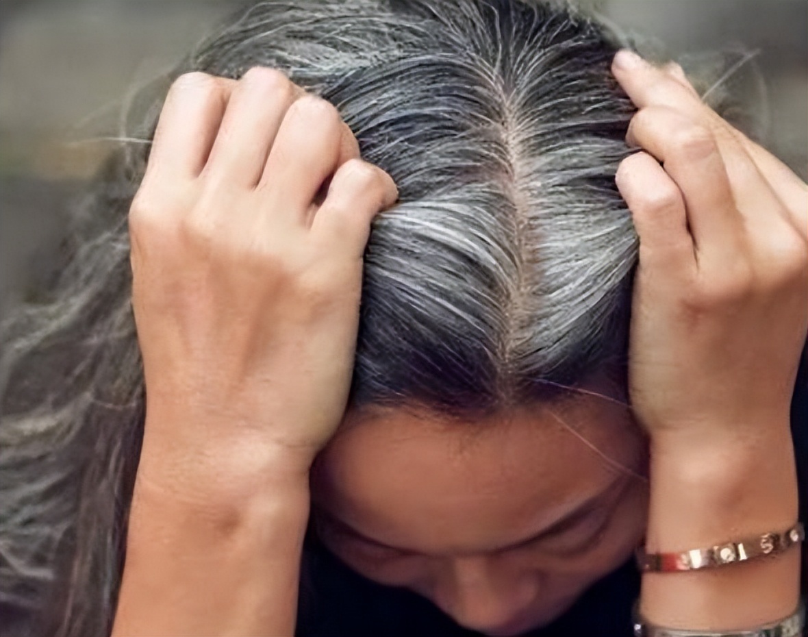 白发在后脑勺两鬓,两鬓和头顶白发后脑勺黑发