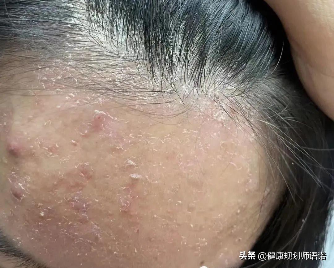 因宫颈问题走进阳光森林，用营养拯救了整个家族的健康