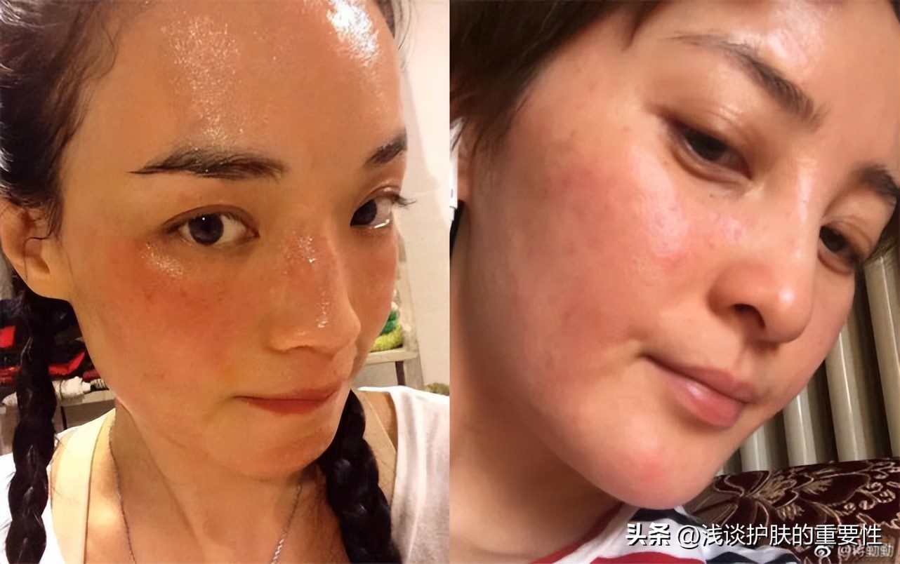 敏敏肌护肤秘籍你get到了吗,敏敏肌可以护肤吗