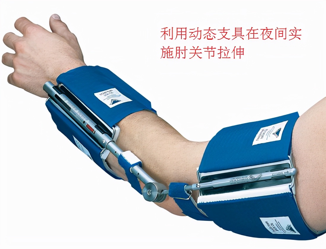 肘关节骨折康复训练正确方法,肘关节骨折术后康复视频