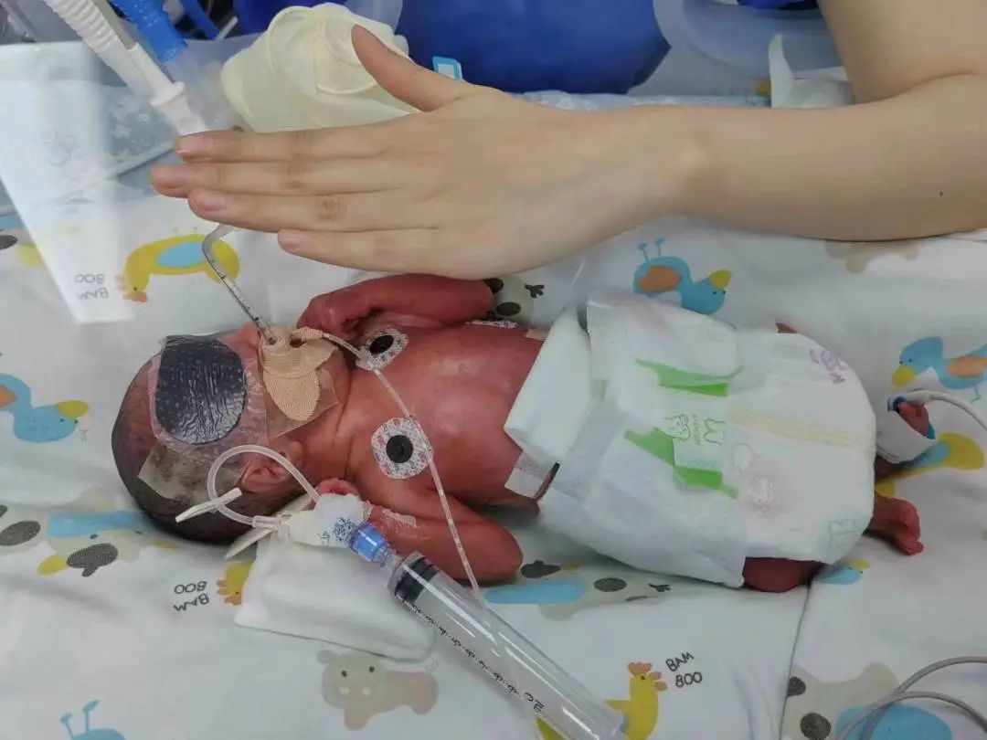 650g、850g、相隔3天出生！这对双胞胎如何“闯”出生命奇迹？