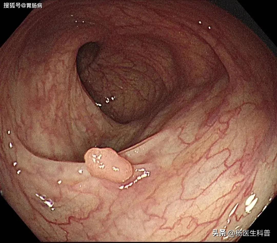 结肠息肉症状和治疗最佳方法,结肠息肉怎么引起来的