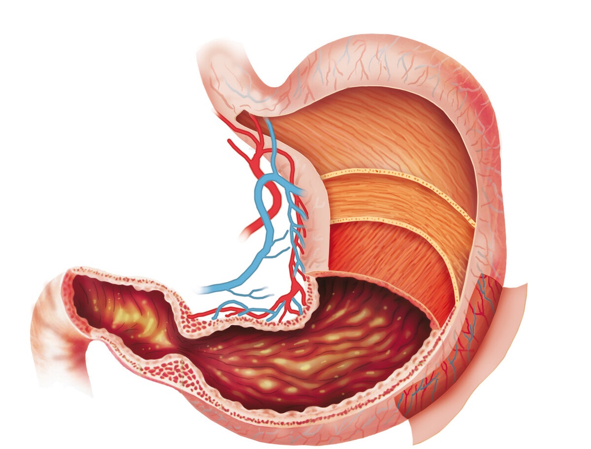 为什么胃病要根治才能调理好,胃病为什么注意饮食还治不好