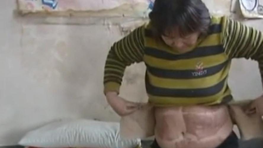 割皮救子父亲康复情况,儿子刚出生为弟弟捐骨髓后续