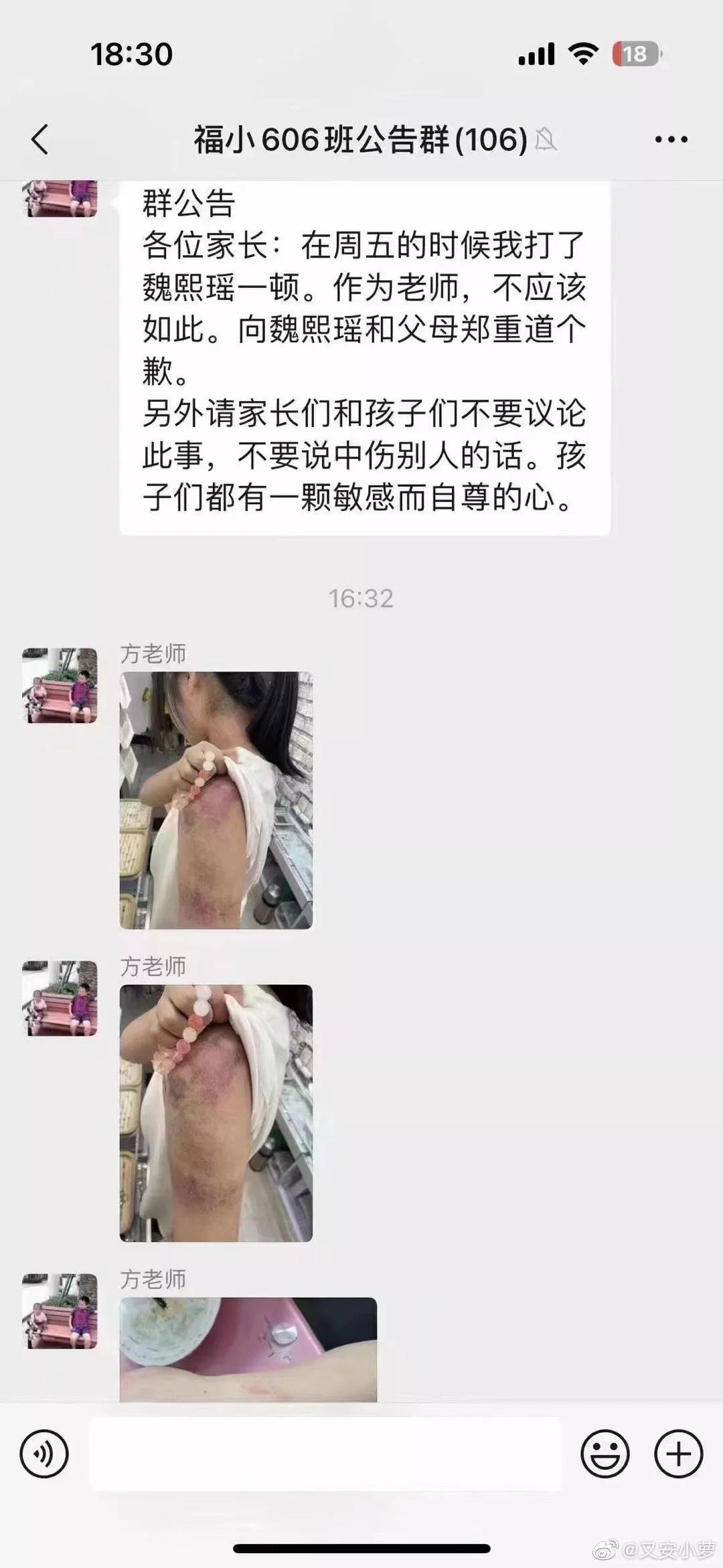 小学老师体罚学生致大片淤青，其他家长却还在拍马屁：老师真负责