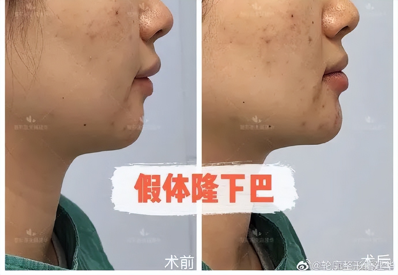 下巴后缩是不是最难看的,下巴后缩明星怎么改善