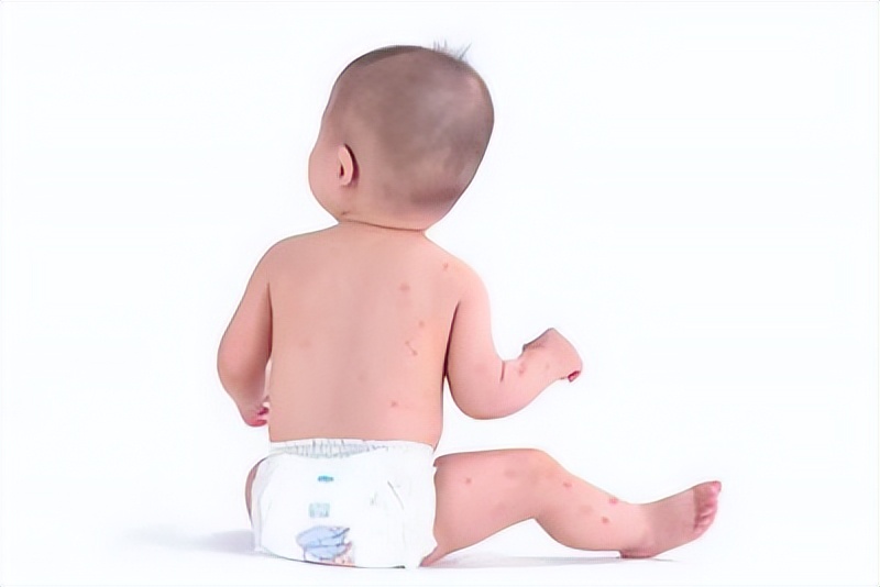 带状疱疹与水痘,带状疱疹与水痘最明显的区别