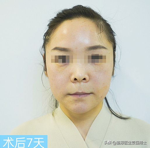 小拉皮20天恢复效果图,拉皮手术后75天复查