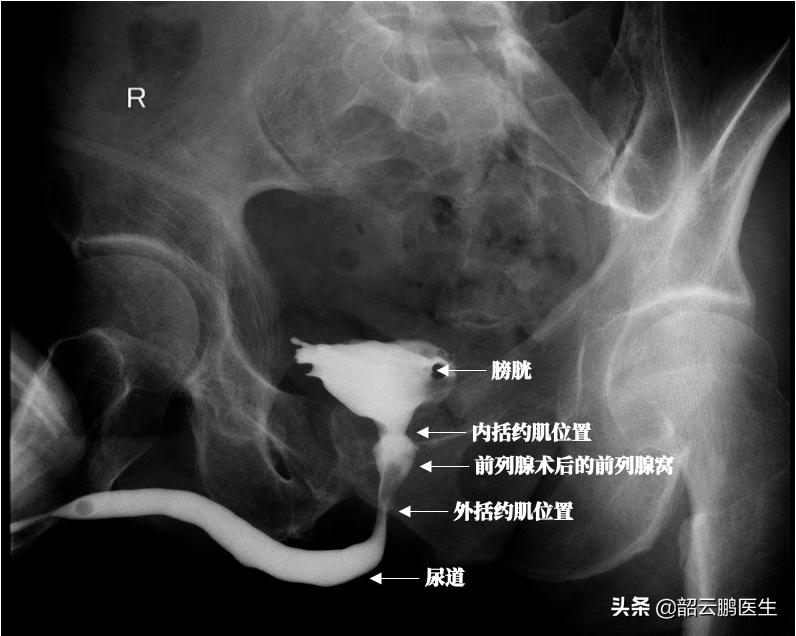 前列腺切除后需要终生戴尿不湿吗,做了前列腺漏尿最有效的恢复方法