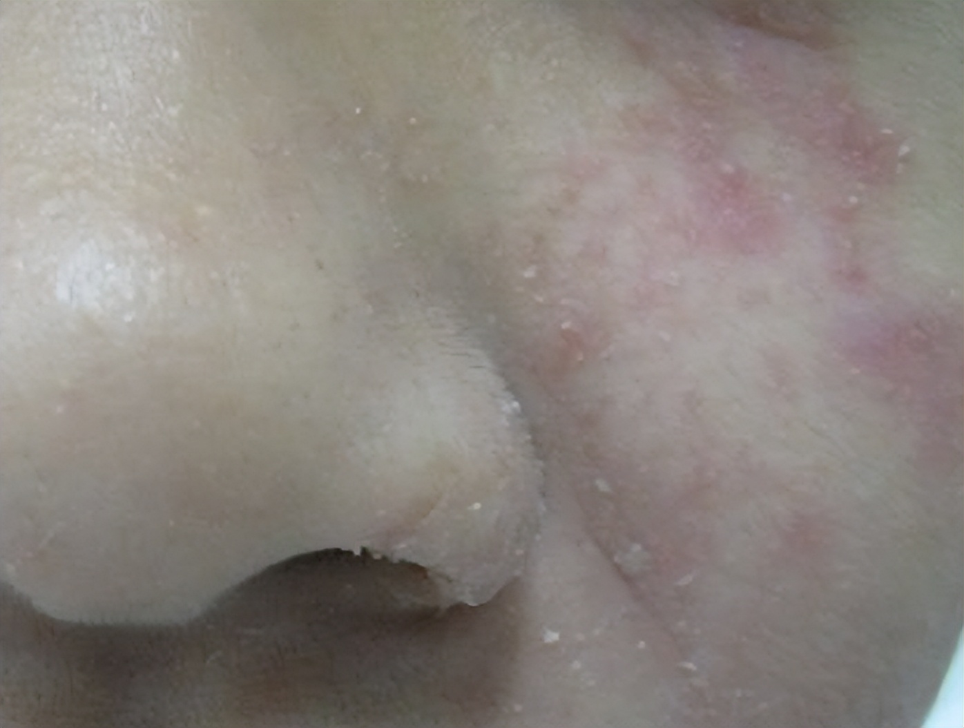 靶向药引起的皮疹怎么处理,靶向药出现皮疹怎么应对