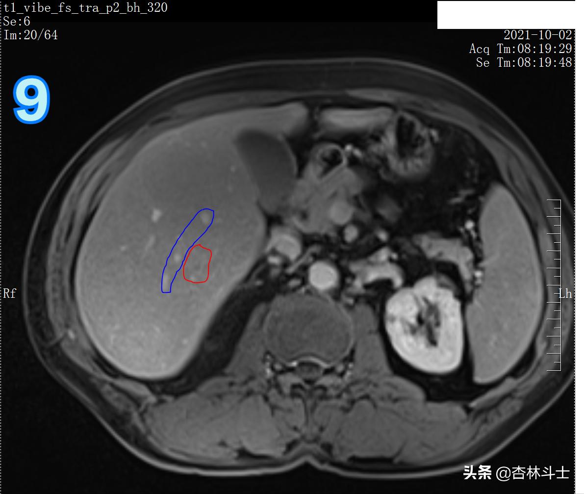 肝癌8公分肿瘤能活多久,肝癌细胞最大长多大
