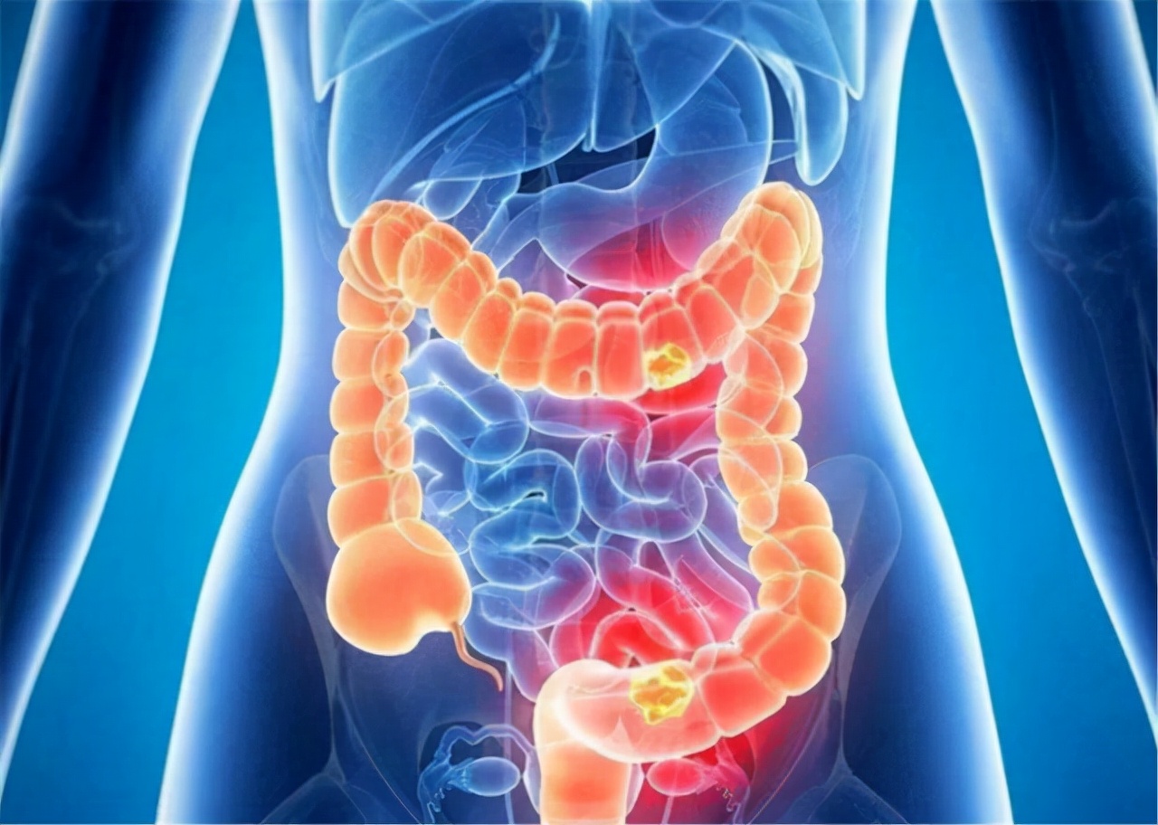 人如果没了“肛门”会怎样？什么情况下，会被切除“肛门”？