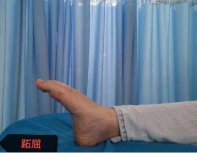 足踝骨折康复,足踝骨折康复训练视频