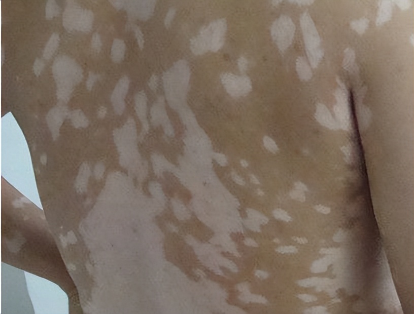 这些你必须知道的美容常识,哪些关于白斑的知识