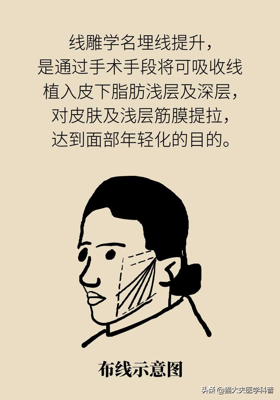 线雕逆龄线可以保持多少年,做了逆生长线雕注意什么