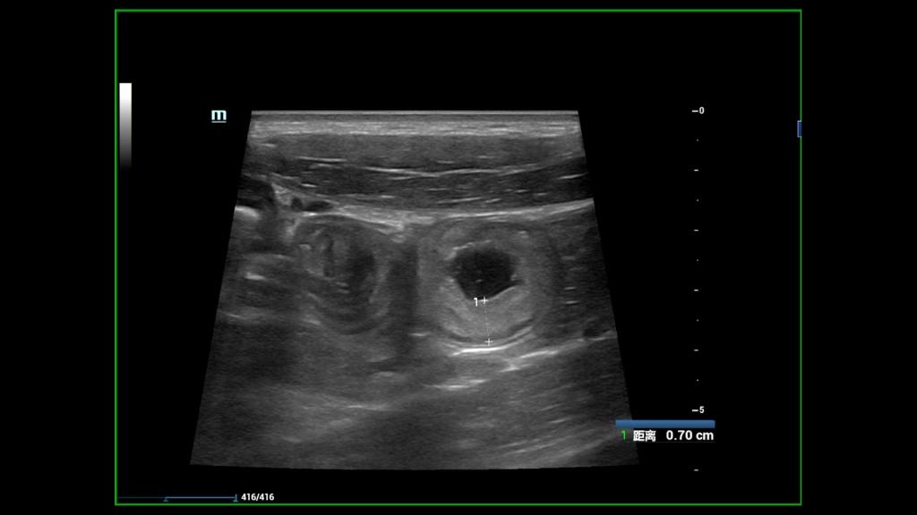株洲市中心医院小儿超声检查克罗恩病为患者排忧解难
