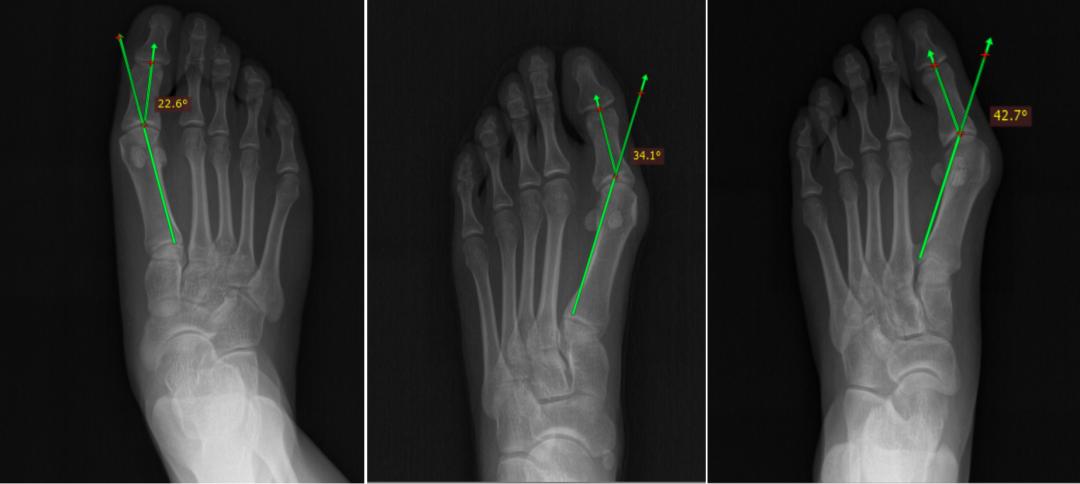 如何让脚趾变美观,小脚趾缺失两节对美观影响吗