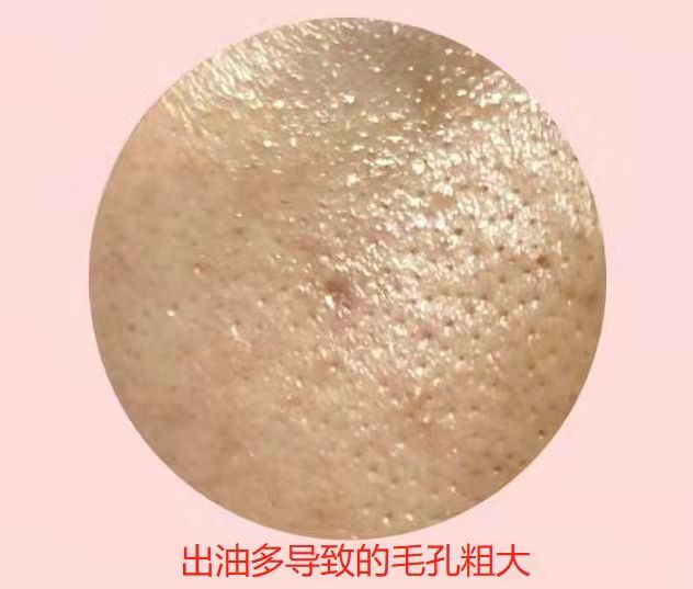 毛孔粗大问题应该如何正确解决,毛孔粗大哪些方法可以得到改善