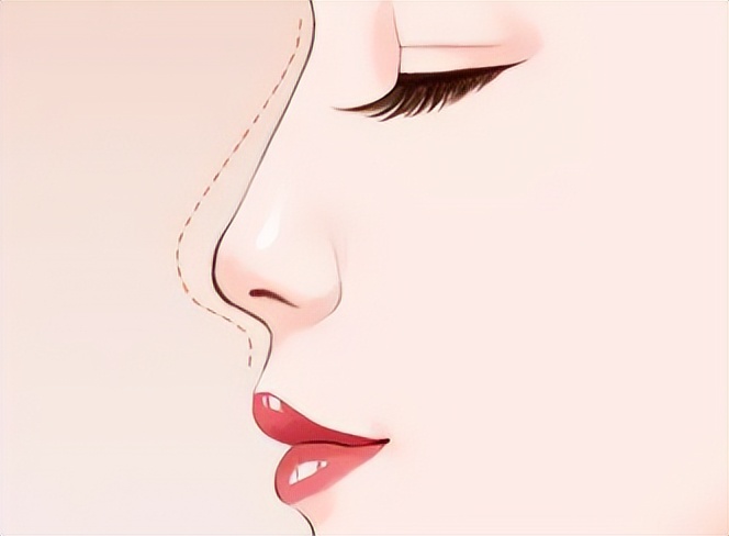 上海九院韦敏隆鼻,九院韦敏技术怎么样