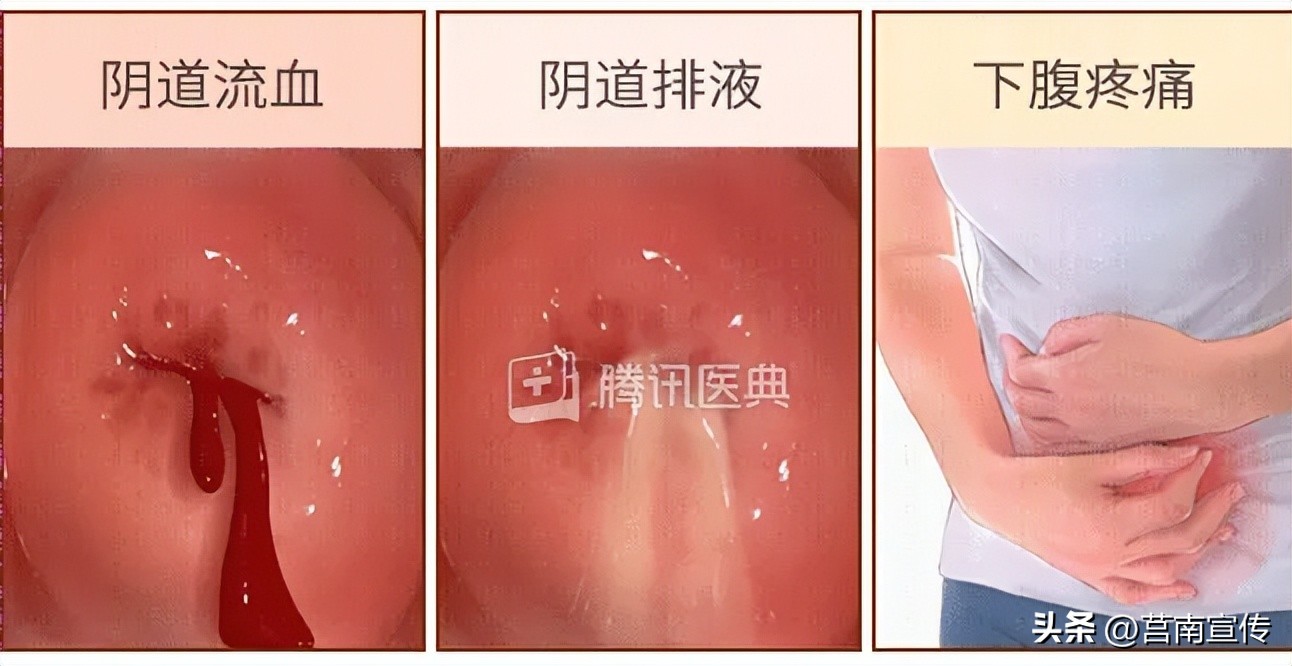 发现息肉，离癌有多远？