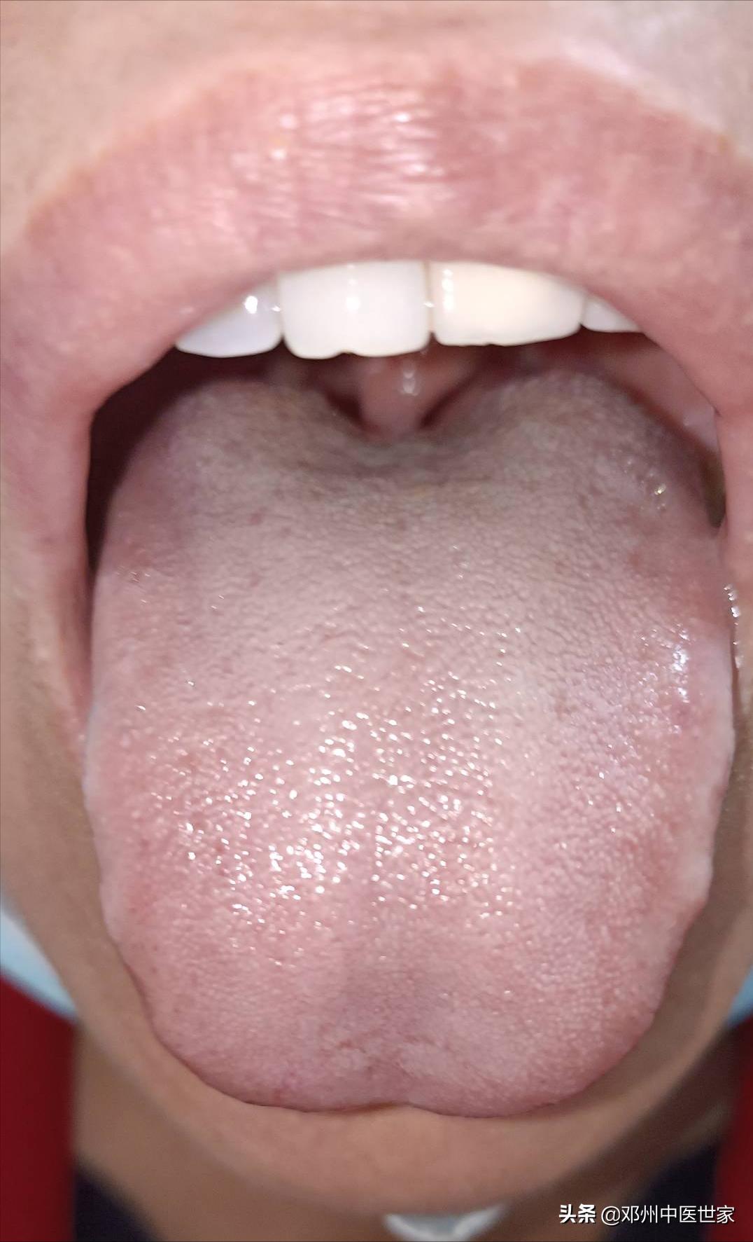 糖尿病并发症引起的皮肤瘙痒,糖尿病引起的皮肤瘙痒中医病例