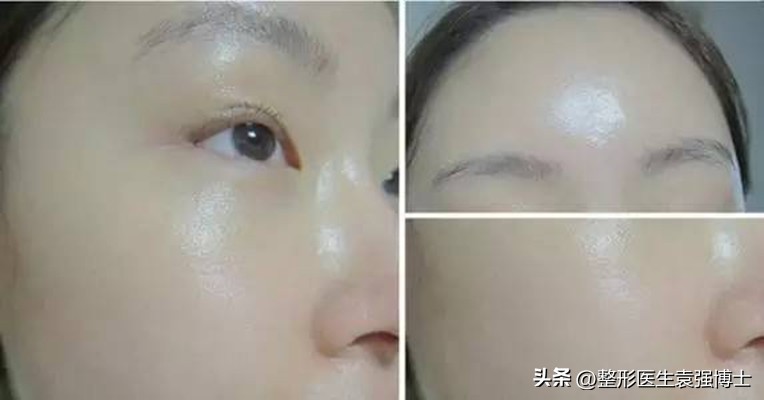 拉皮术后10年真实状态揭秘,拉皮手术后会经历的恢复阶段