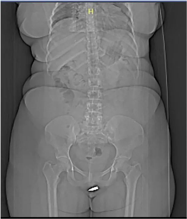 24岁女子意外被*弹子**击中，并卡在阴部，为医疗史上的首次记录