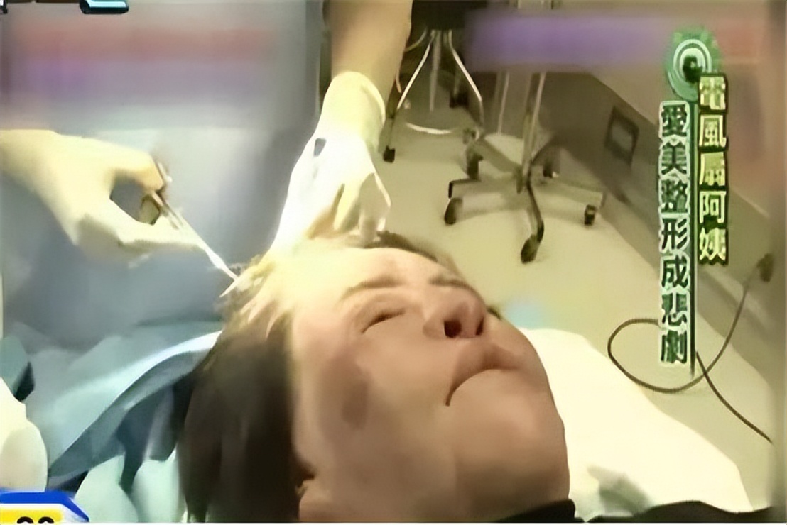 韩慧景整容是打了玻尿酸了吗,韩慧景整容案例