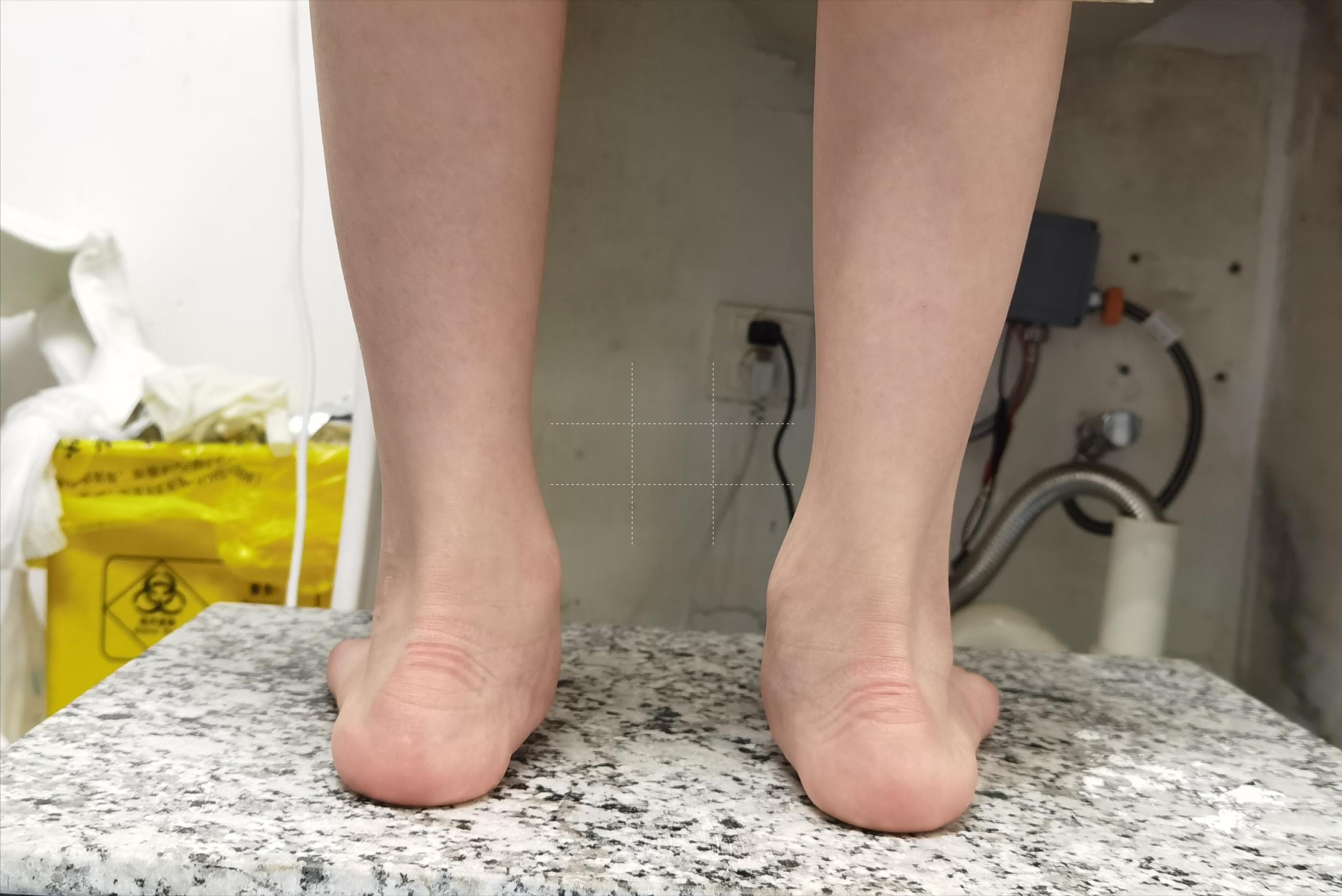 扁平足穿鞋垫能矫正过来吗,僵硬型扁平足矫正鞋垫有效果吗