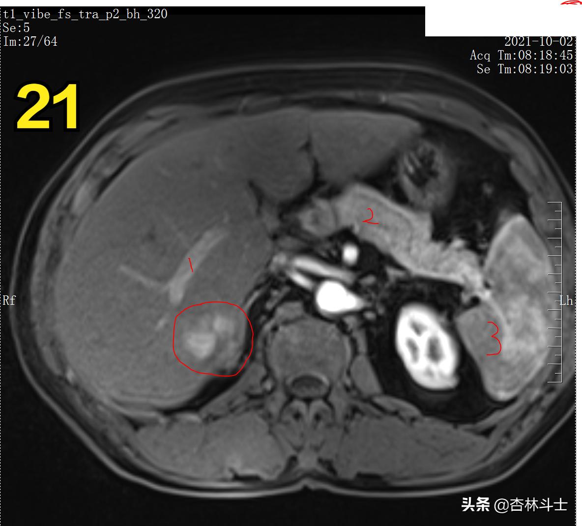 肝癌8公分肿瘤能活多久,肝癌细胞最大长多大