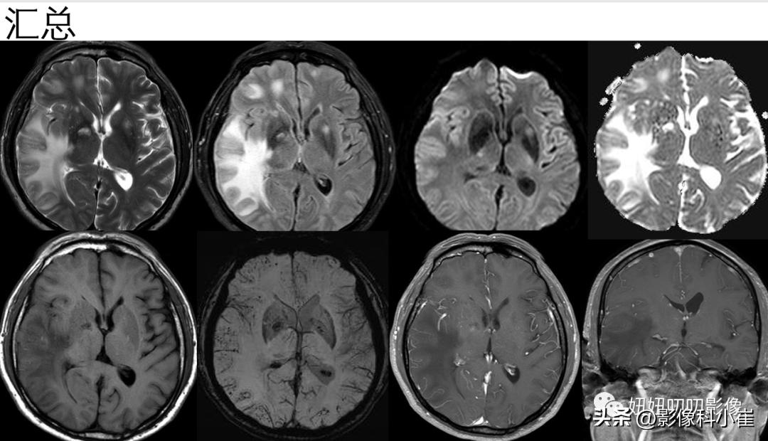 脑部肿瘤疾病有哪些,脑部有病变但是不是肿瘤