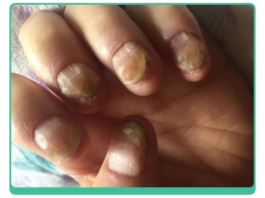 白斑、薄脆、凹陷，娃指甲有异常，不是缺营养，可能暗藏疾病