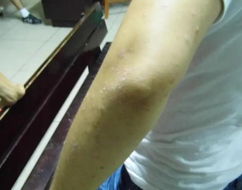 广汗法治疗银屑病效果怎么样,汗法治疗银屑病