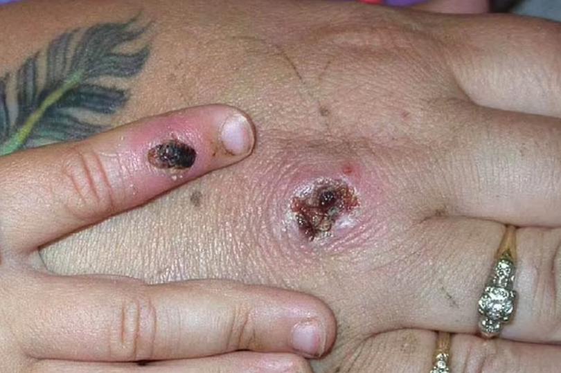 卑诗省有2例猴痘患者？省府回应来了脓肿溃烂目前无药可治