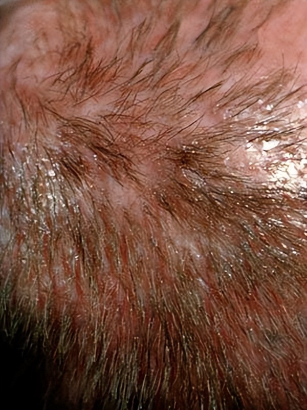 脱发很严重什么原因引起的,脱发是怎么引起的要注意什么