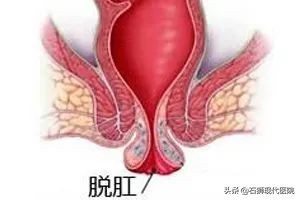 排便脱肛是怎么回事,排便太用力了有点脱肛是什么原因